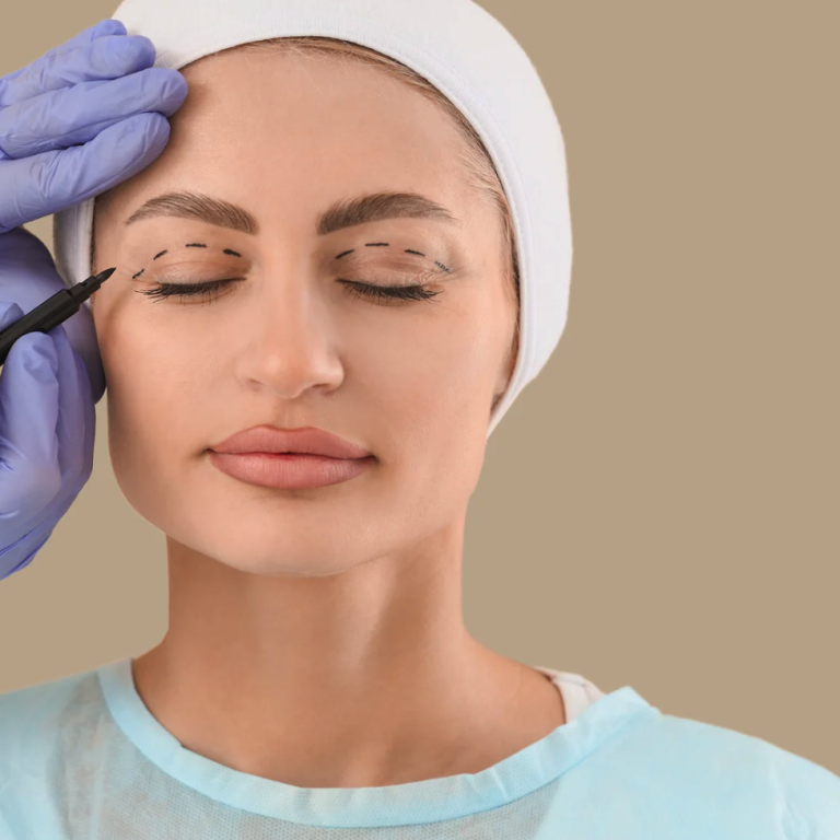 blepharoplasty-1